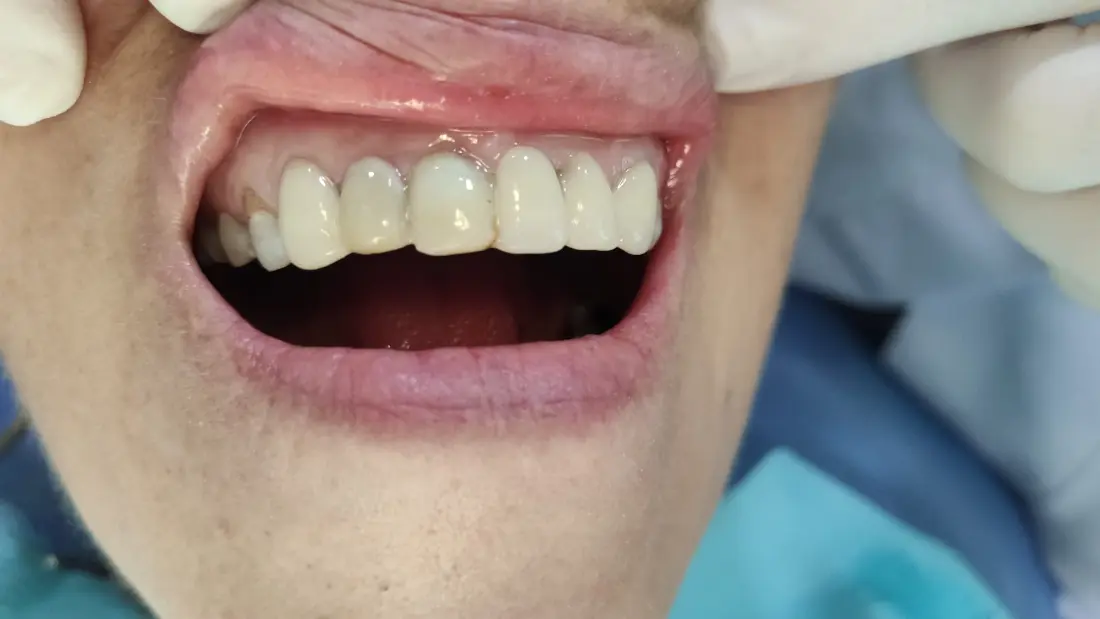Sonrisa renovada gracias a la Odontología Estética.